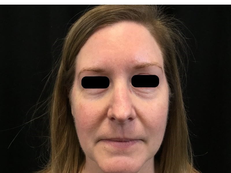 Juvederm Voluma- Tear Troughs Before