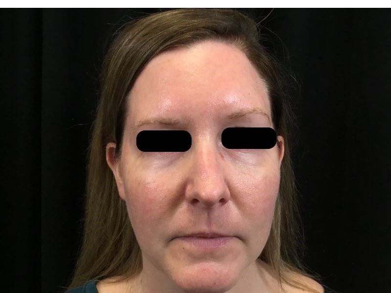 Juvederm Voluma- Tear Troughs After