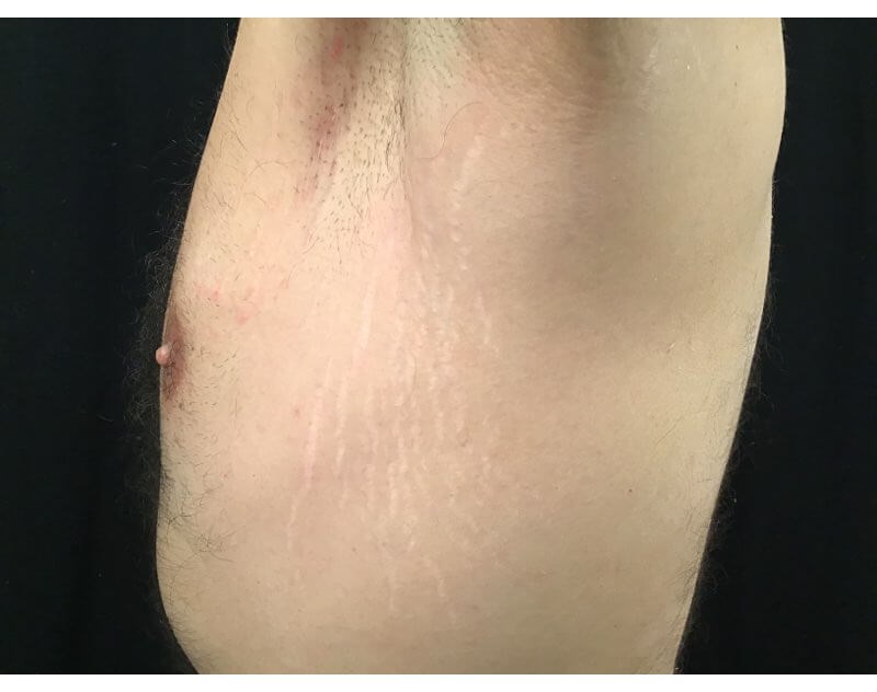 Microneedling with SkinPen Before