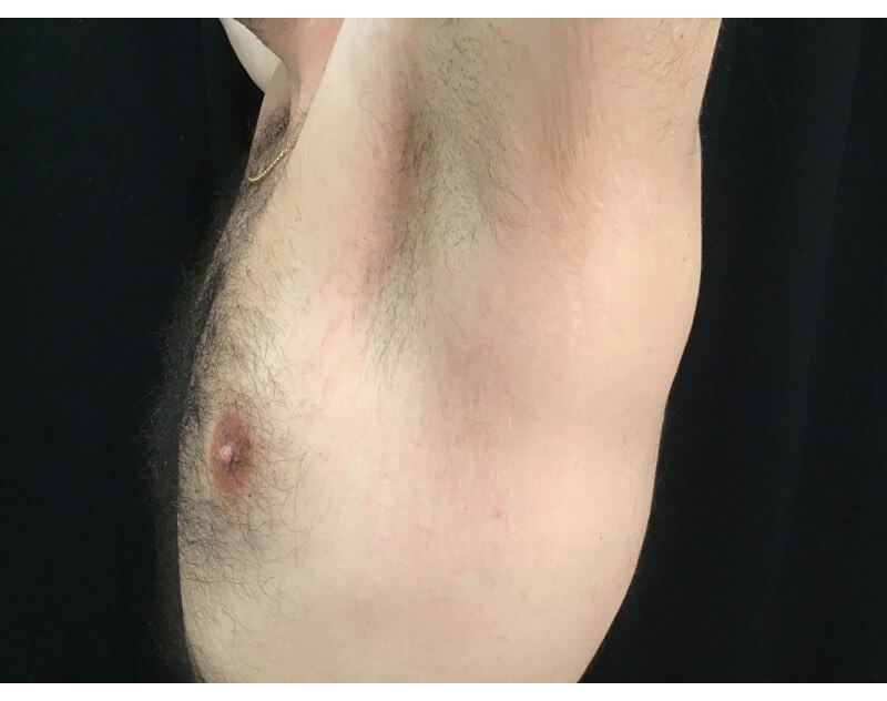 Microneedling with SkinPen After