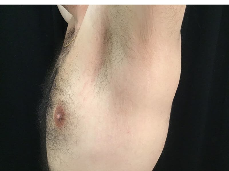 Microneedling with SkinPen After