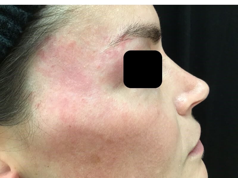 Sciton BBL-Port Wine Stain After