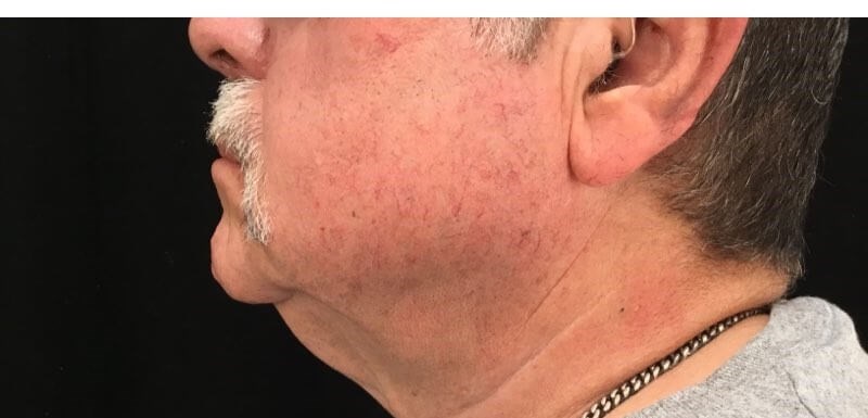 Sciton BBL-Telangiectasia After