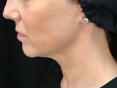 Ultherapy After