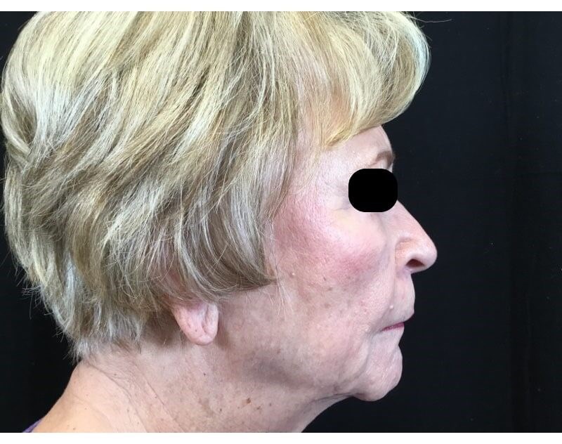 Juvederm Volux Jawline Before