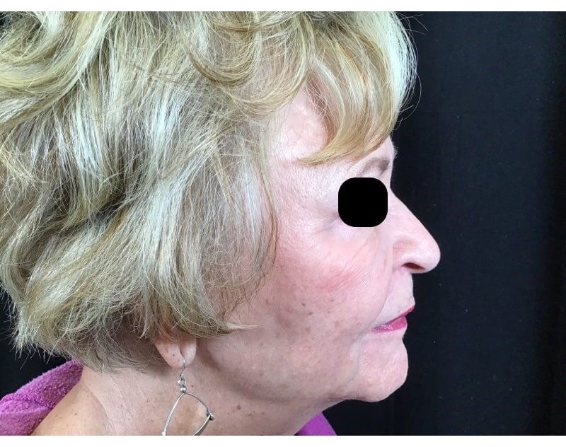 Juvederm Volux Jawline After