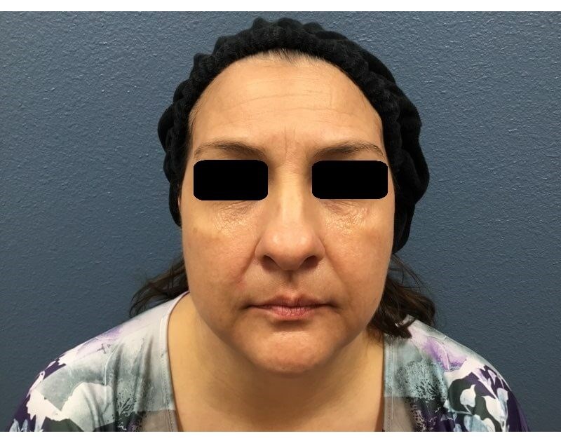 Juvederm Vollure Before