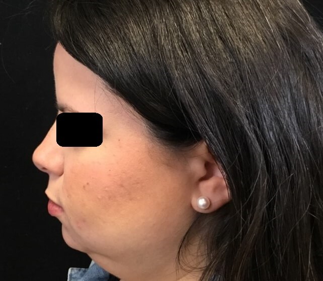 Kybella for under chin Before