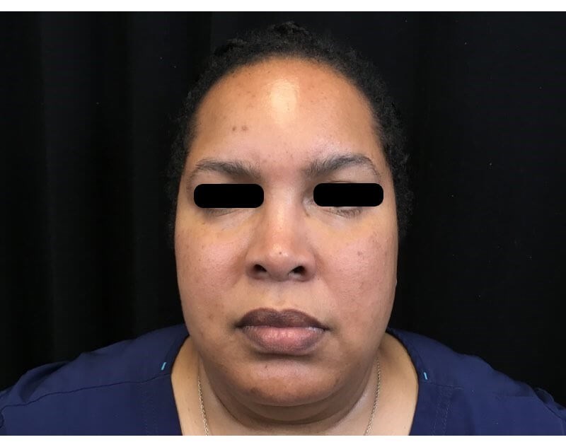 Vollure & Voluma Treatment After