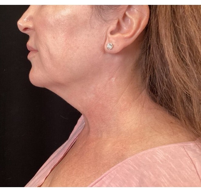 Ultherapy Lower Face After