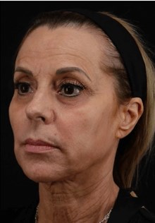 Juvederm Voluma Temples/Cheeks Before