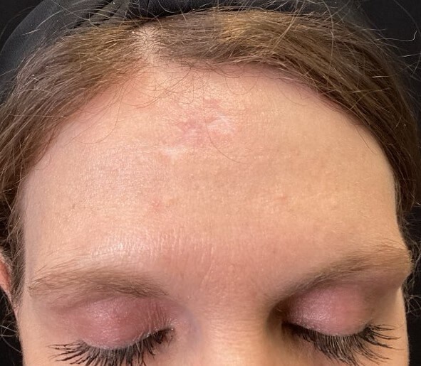 Profractional Laser Treatment After