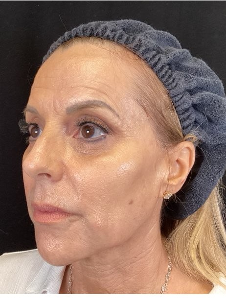 Juvederm Voluma Temples/Cheeks After