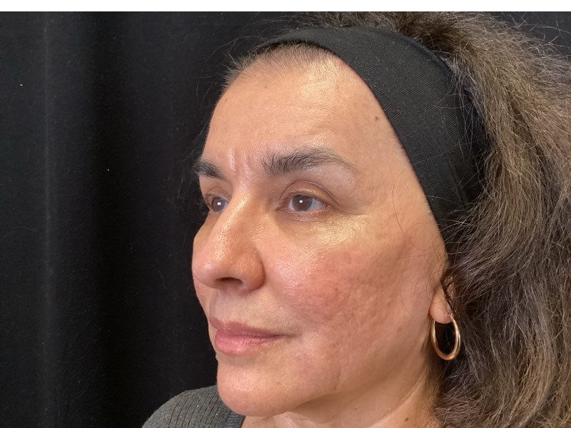 Profractional & Juvederm After