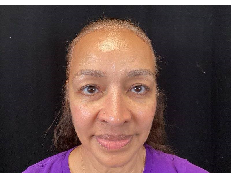 Vollure & Voluma Treatment After