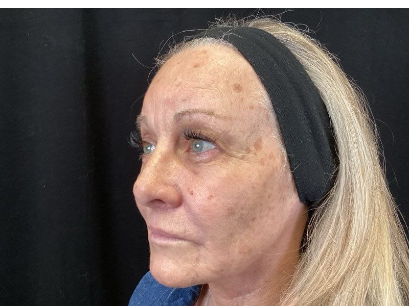 Juvederm Collection of Fillers After