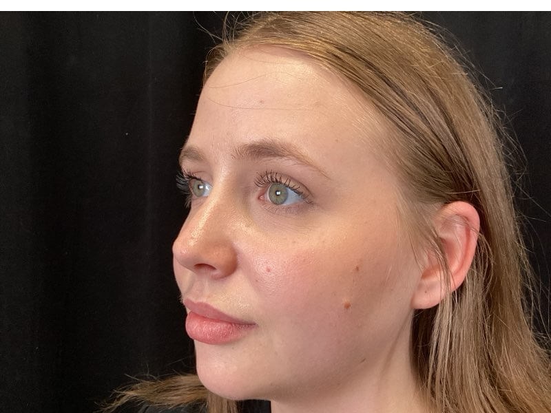 Volux & Voluma Treatment After
