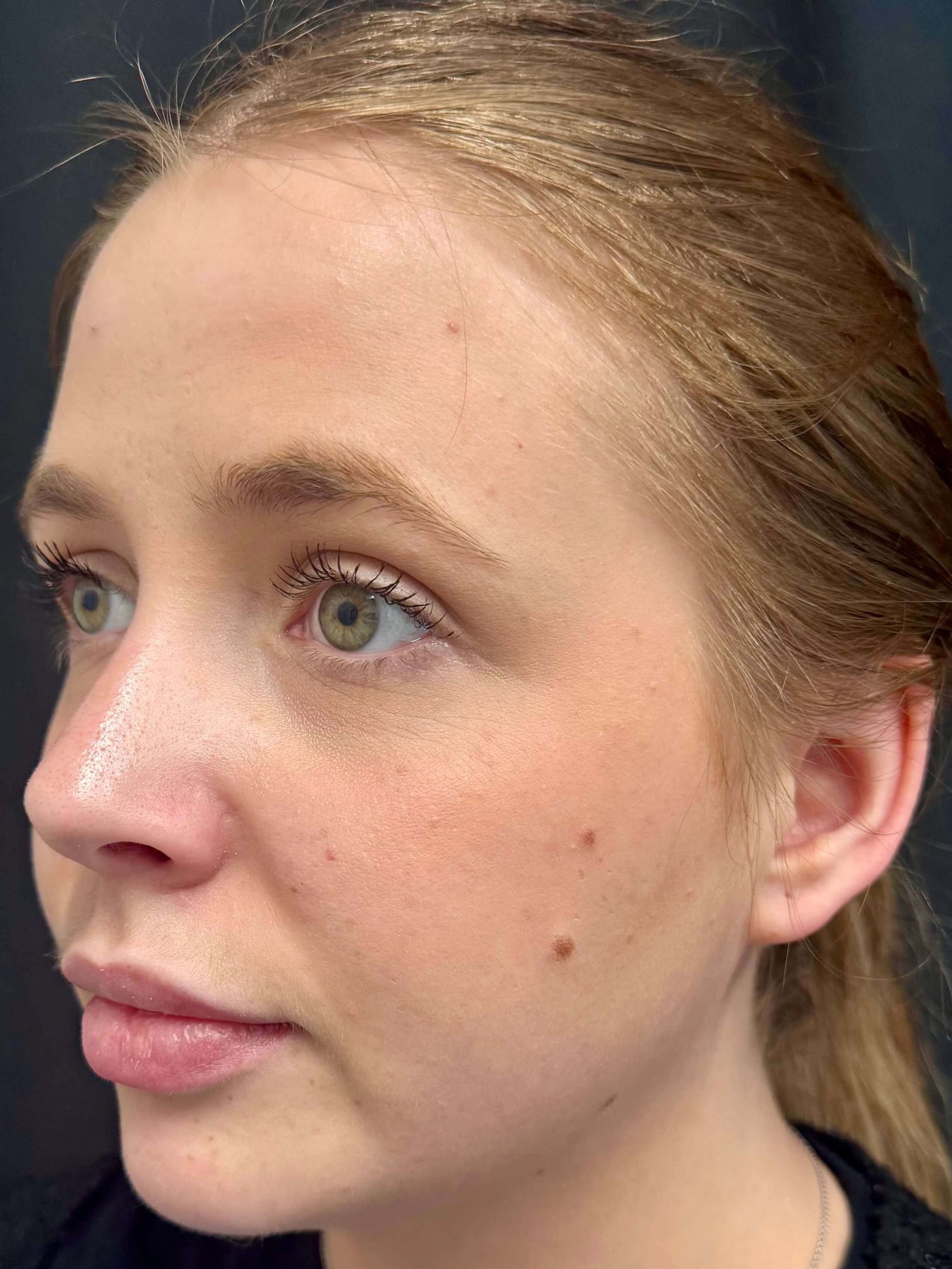 Volux & Voluma Treatment Before