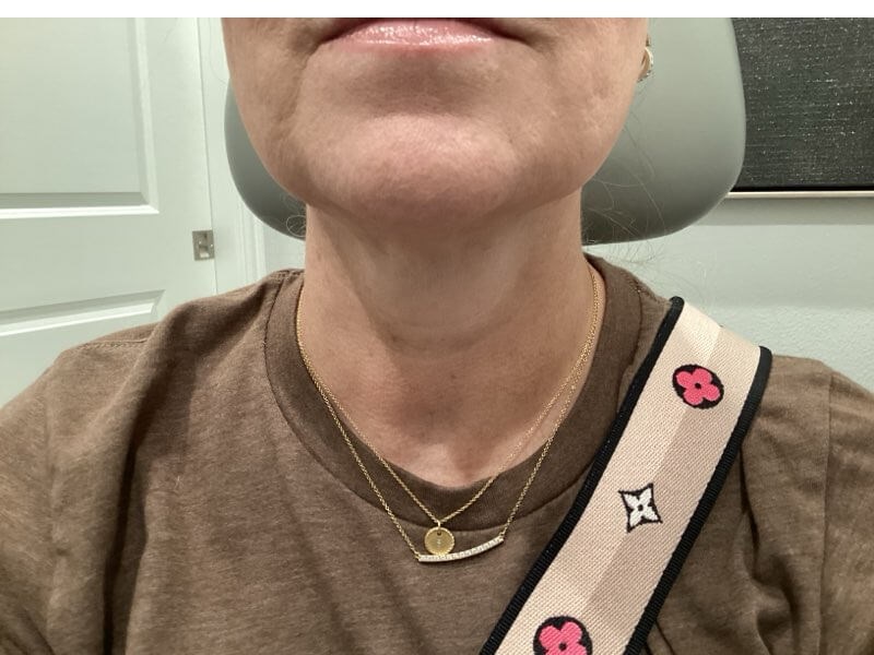 Botox for Platysma Bands After Relaaxed