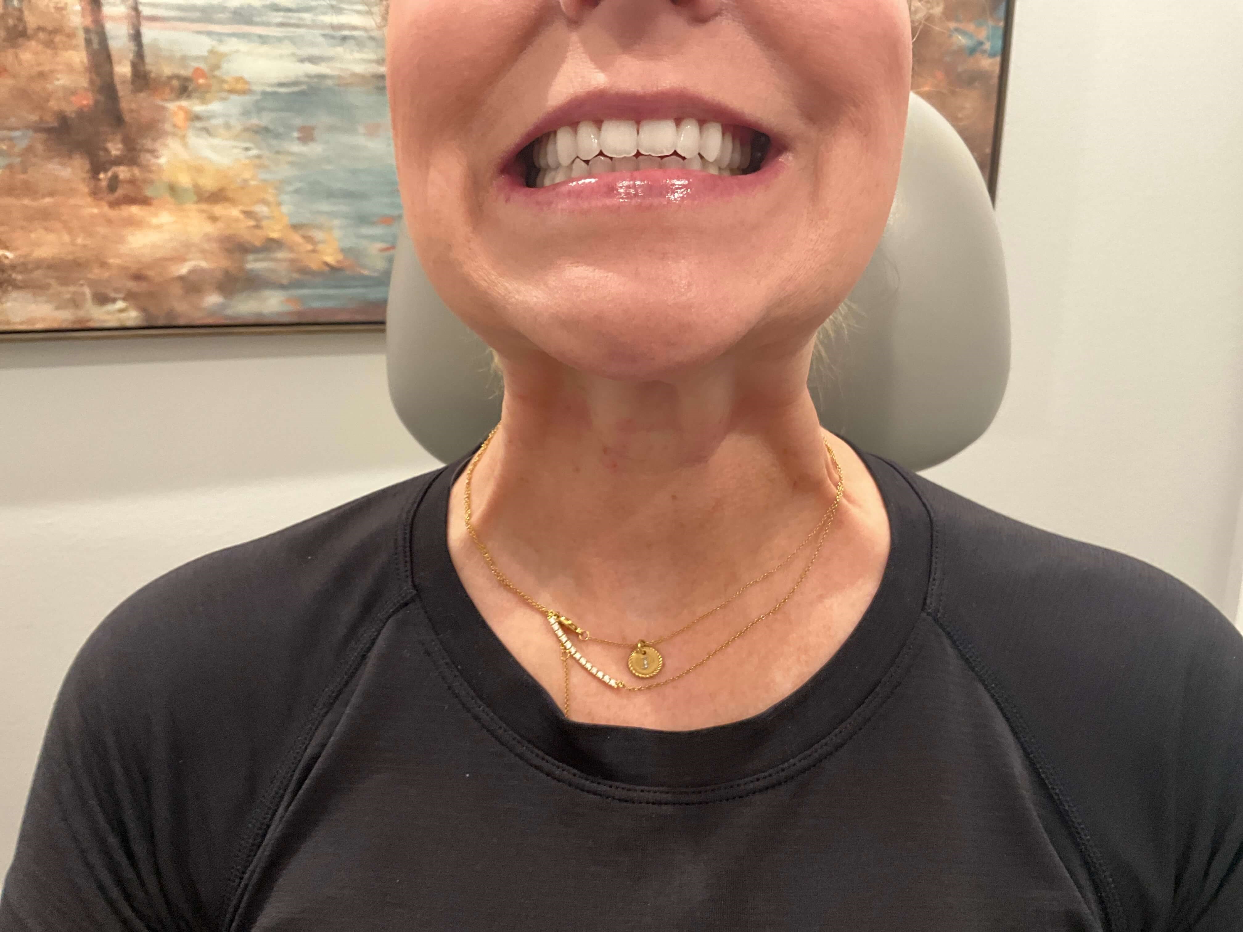 Botox for Platysma Bands Before Contracted