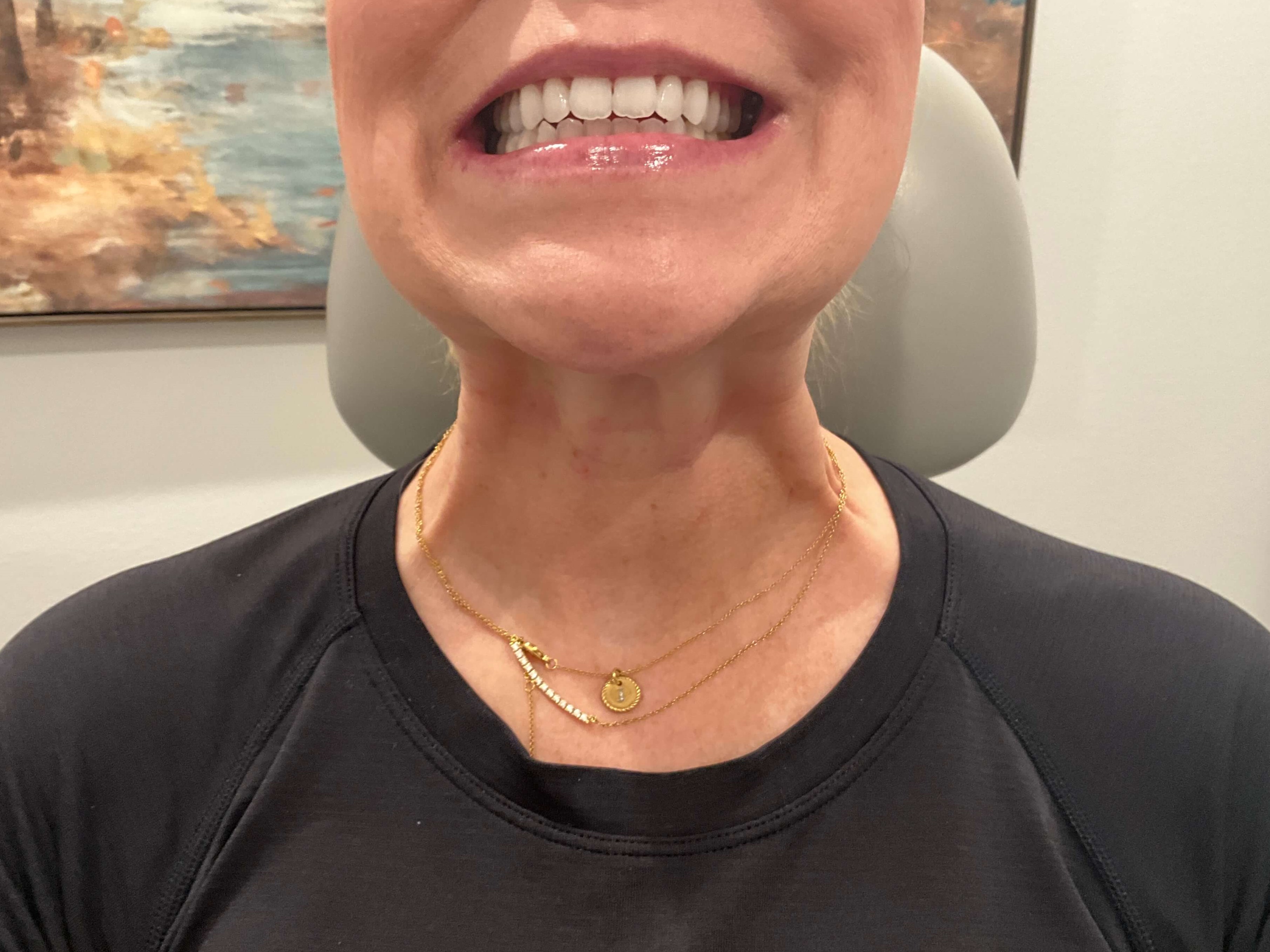 Botox for Platysma Bands Before Contracted