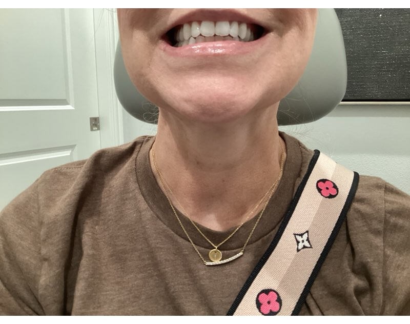 Botox for Platysma Bands After Contracted