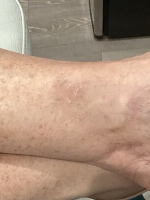 Spider Vein Treatment After