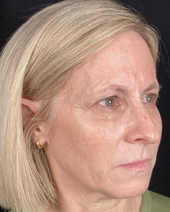 Botox, Voluma, Vollure Before