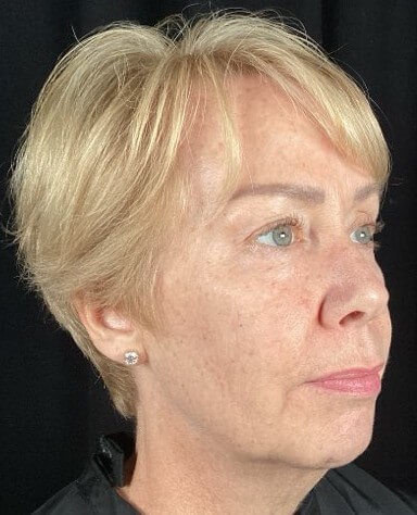 Juvederm Voluma and Volux Before