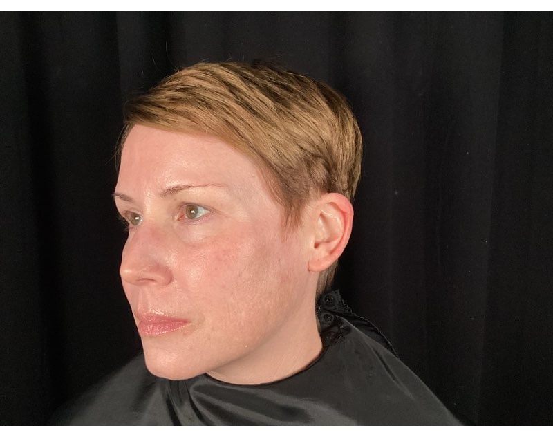 Lutronic Laser Treatment After