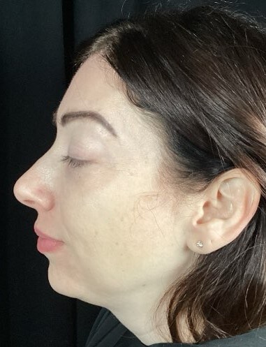 Juvederm Volux and Skinvive Before