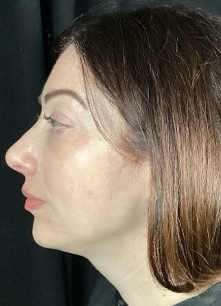 Juvederm Volux and Skinvive After