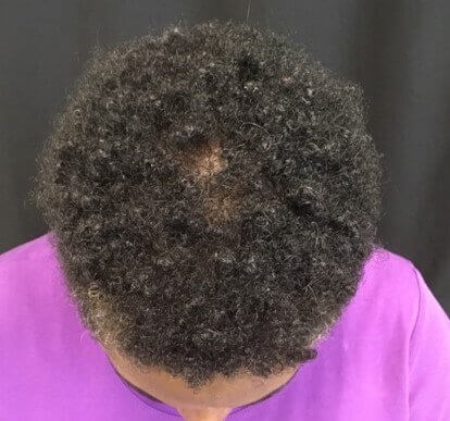 Alopecia Before & After After