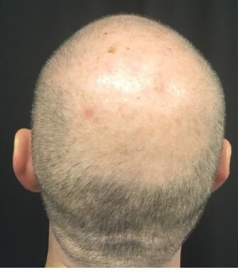 Hair Loss Before & After Before