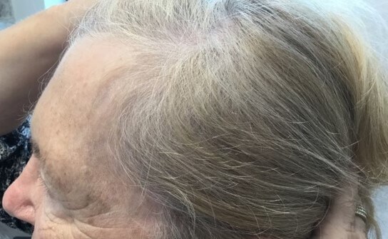 Hair Loss Before & After After 4 months