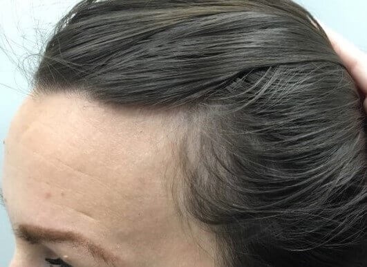Hair Loss Before & After Before