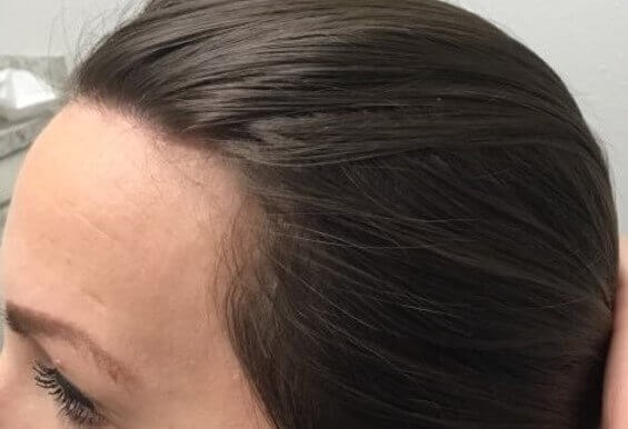 Hair Loss Before & After After 3 months