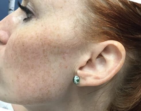 Surgical Excision After 6 months