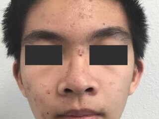 Profrac Laser Before