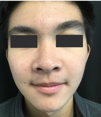 Tattoo Removal - Frisco, TX: Legacy MD