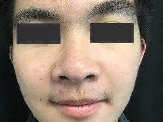 Affordable Laser Skin Resurfacing Options 1 380736
