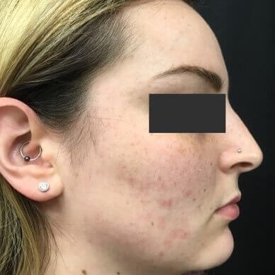 Acne Treatment Before & After After 3 months