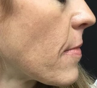 Hormonal Acne Before & After After 5 months