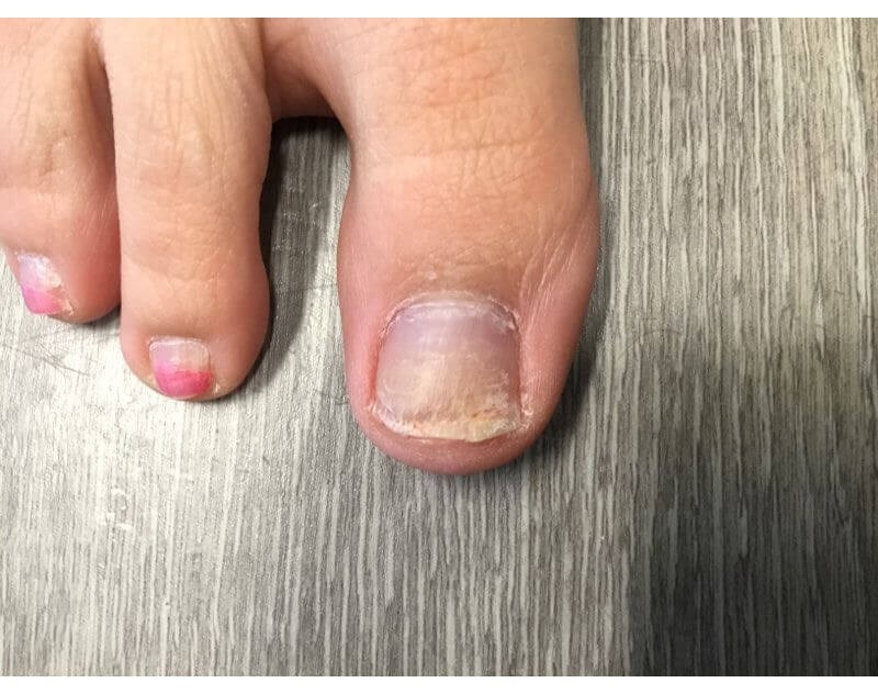 Onychomycosis After