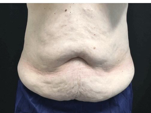 Trusculpt Before