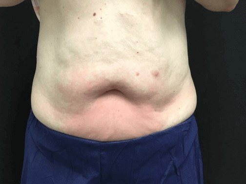 Trusculpt After