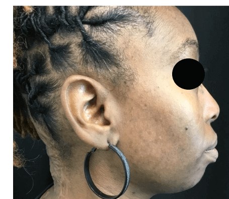 Acne/PIH After