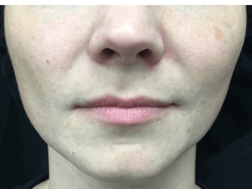 Juvederm Injections Before
