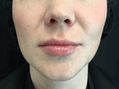 Juvederm Injections After