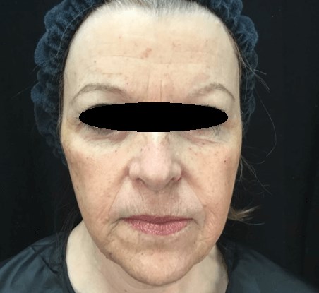 Filler and Botox Before